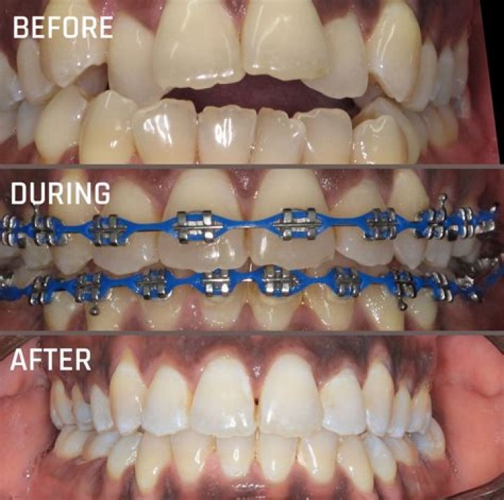 Are teeth braces magnetic?