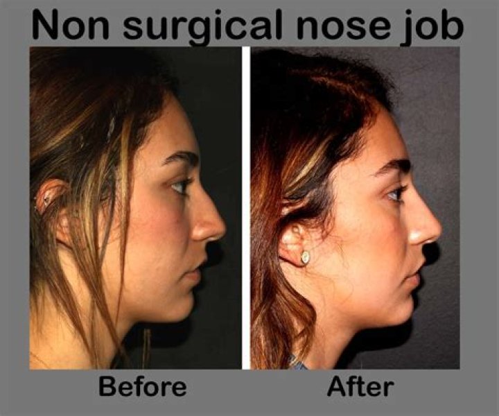 Can a 14 year old get a non surgical nose job?