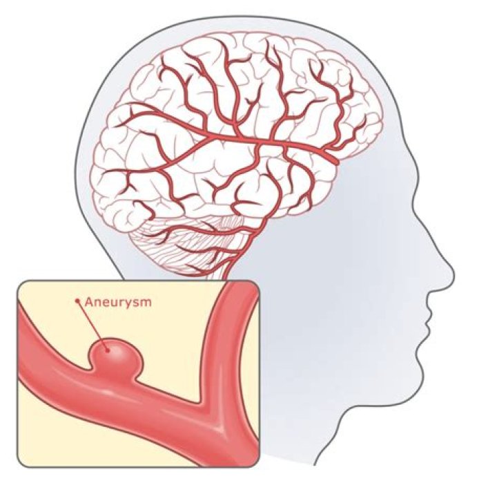 Can a 2mm aneurysm rupture?
