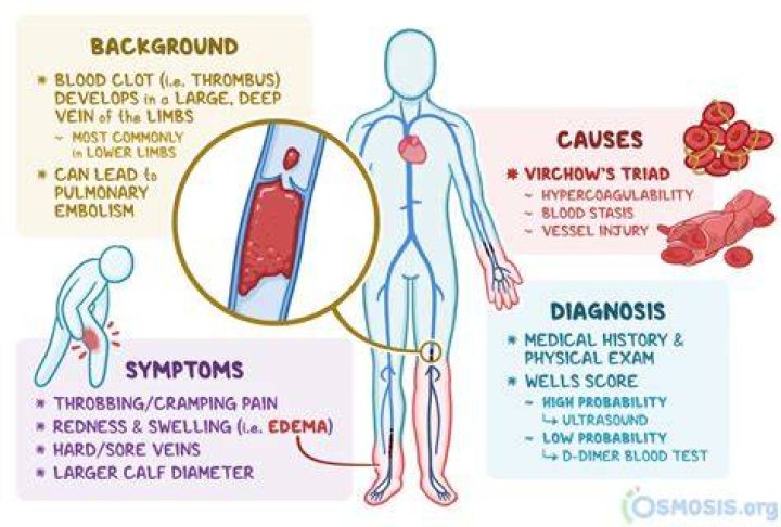 Can a blood clot cause a migraine?