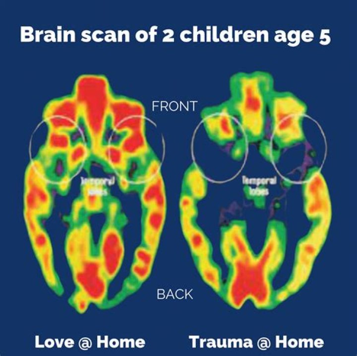 Can a brain scan show epilepsy?