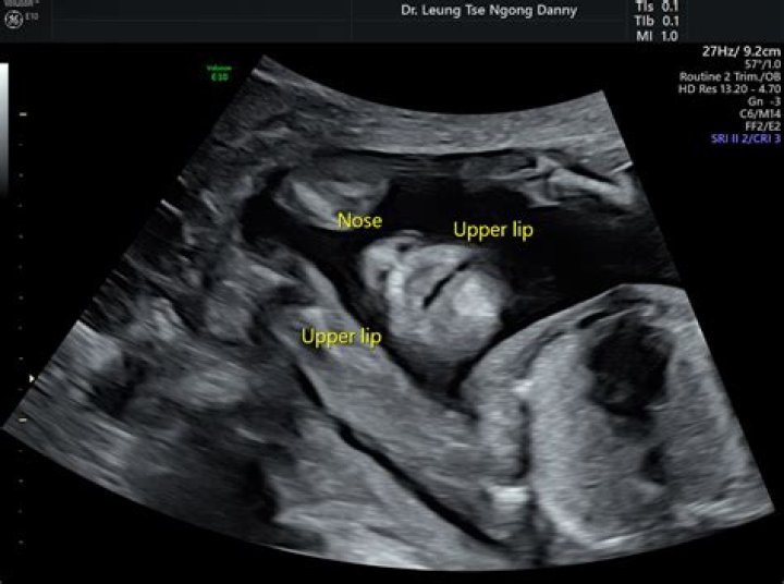 Can a cleft lip be seen on ultrasound?