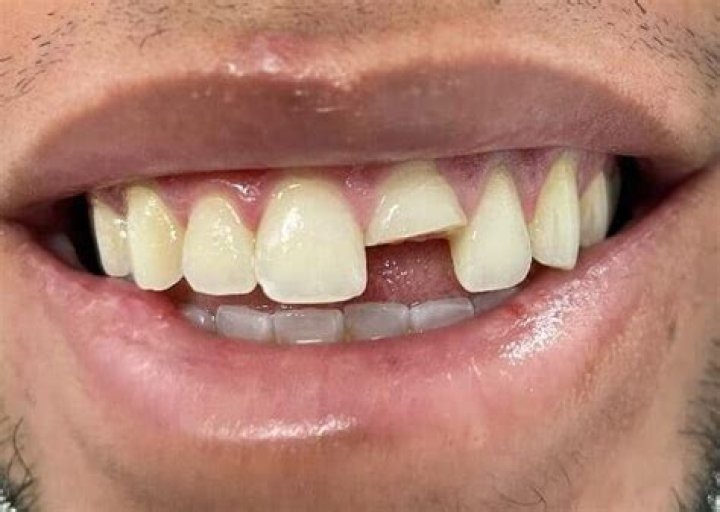 Can a fractured tooth be saved?
