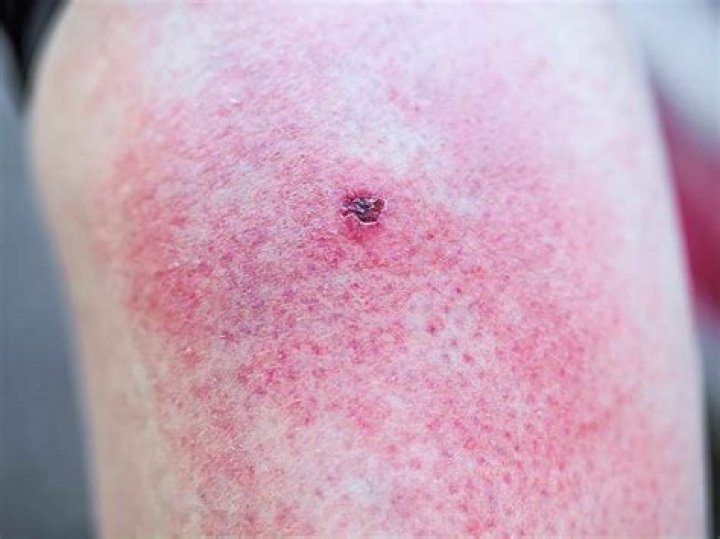 Can a gnat bite cause swelling?