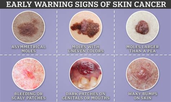 Can a melanoma look like a wart?