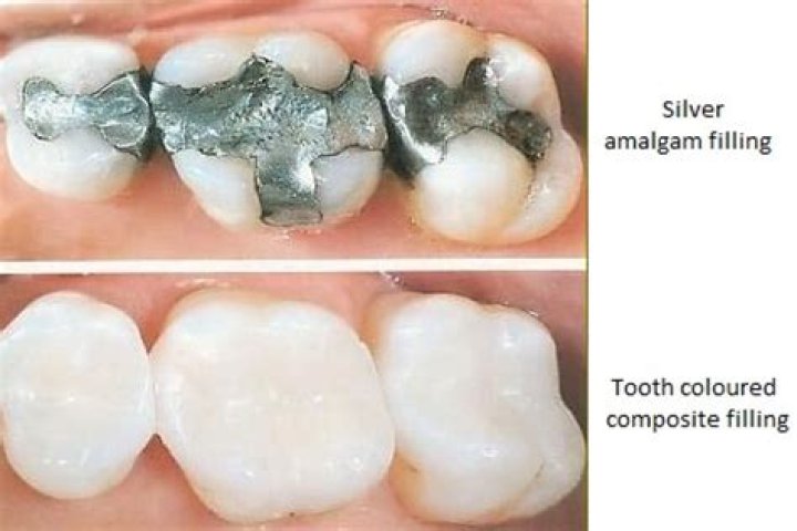Can a regular dentist remove amalgam fillings?