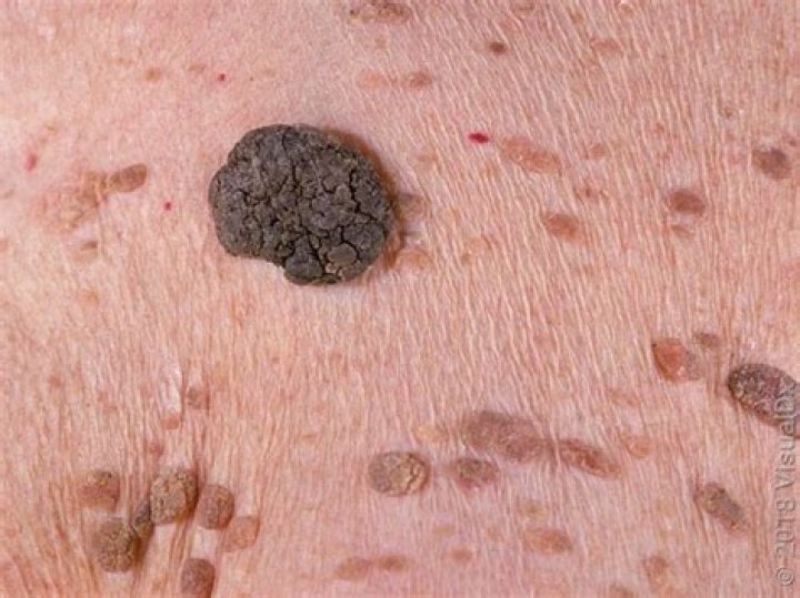 Can a seborrheic keratosis bleed?
