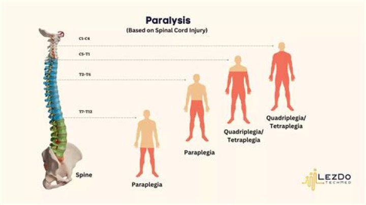 Can a spinal injury cause temporary paralysis?