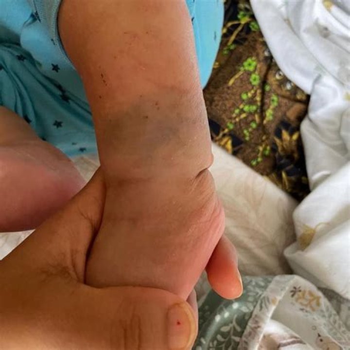 Can a tattoo go over a birthmark?
