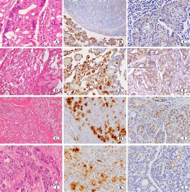Can acinic cell carcinoma spread?
