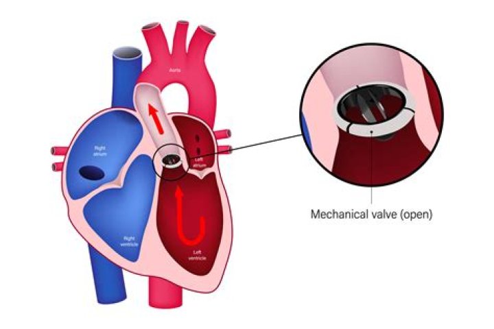 Can an aortic valve replacement cause tachycardia?