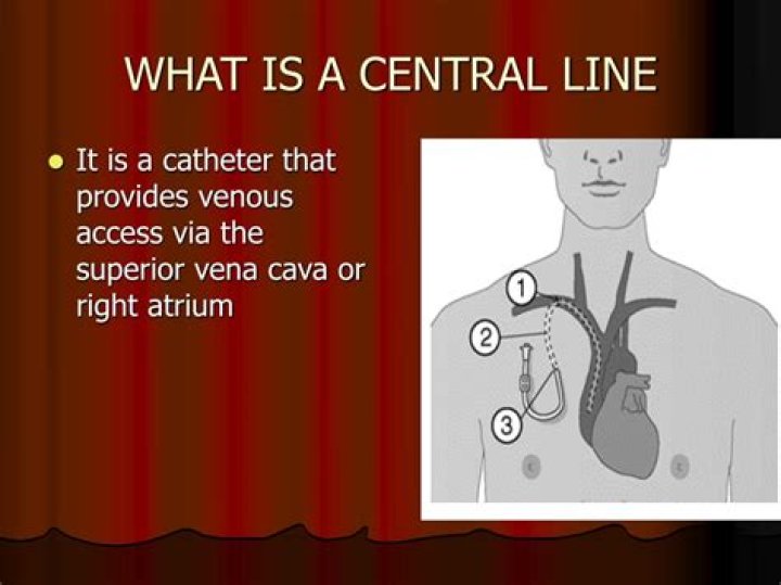 Can an RN pull a central line?