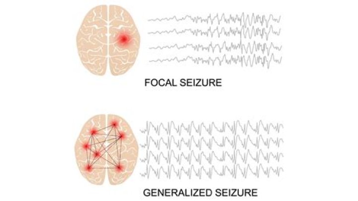 Can audio trigger seizures?