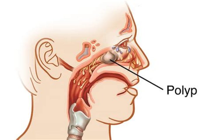Can benign uterine polyps bleed?