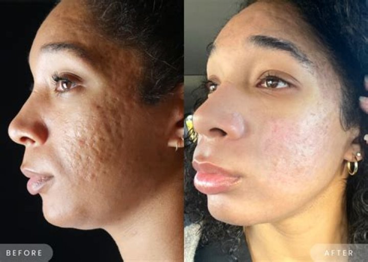 Can Betasol be used on the face?