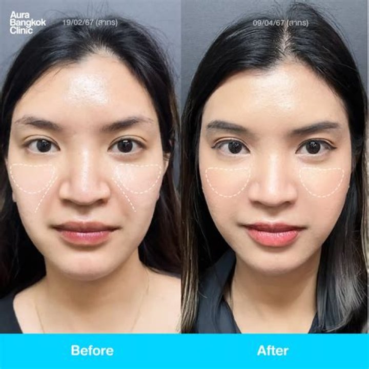 Can Botox be injected in nasolabial folds?