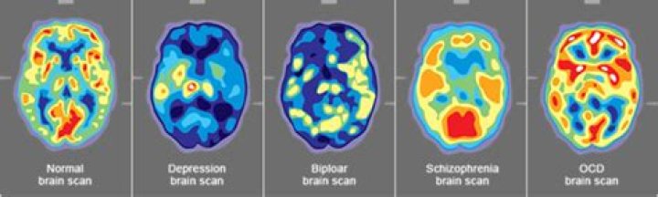 Can brain scans show mental illness?
