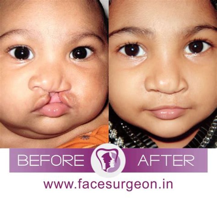 Can cleft palate be healed before birth?