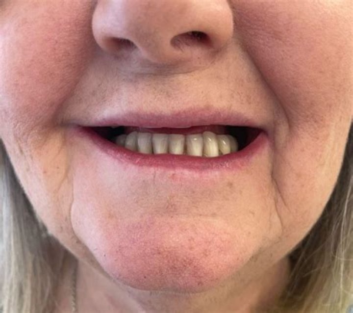 Can dentures lift your face?