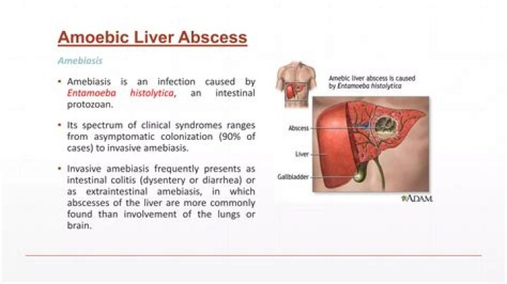 Can E coli cause liver abscess?