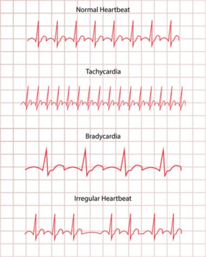 Can ECG detect arrhythmia?
