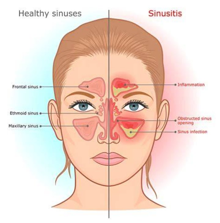 Can ethmoid sinusitis cause vision problems?