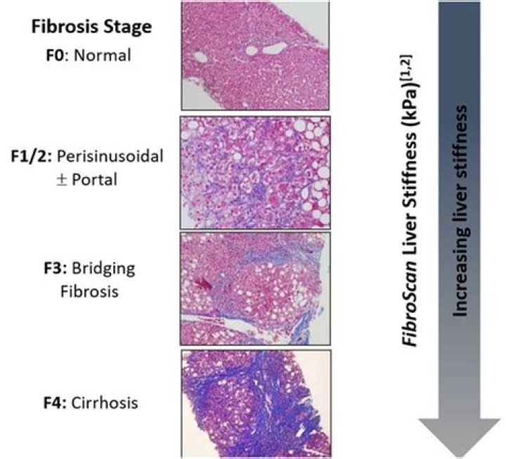 Can f4 liver fibrosis be reversed?