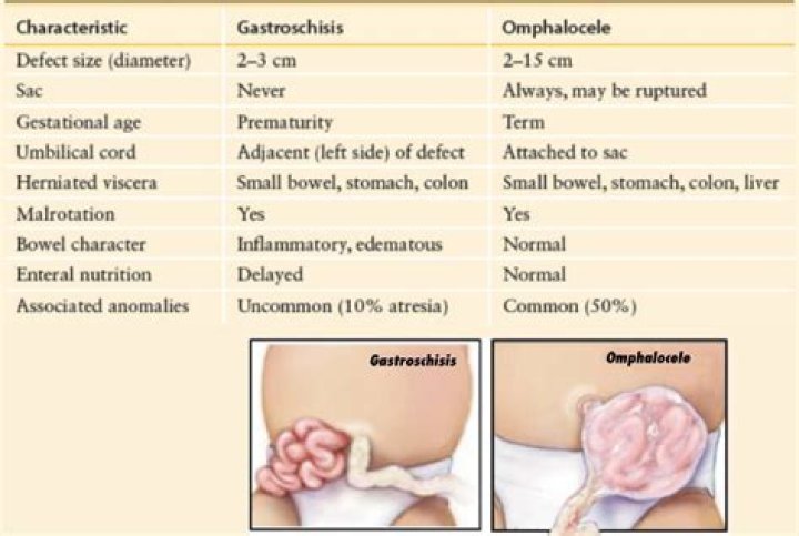 Can gastroschisis be fixed in utero?
