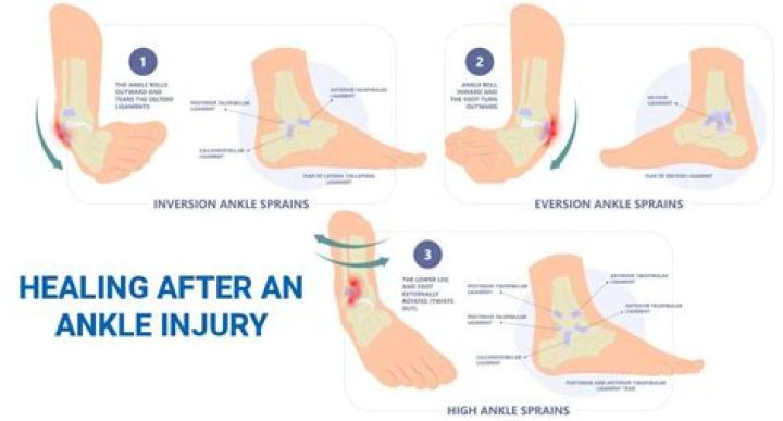 Can gout cause a sprained ankle?