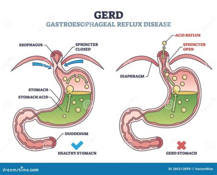 Can Hormonal changes cause acid reflux?