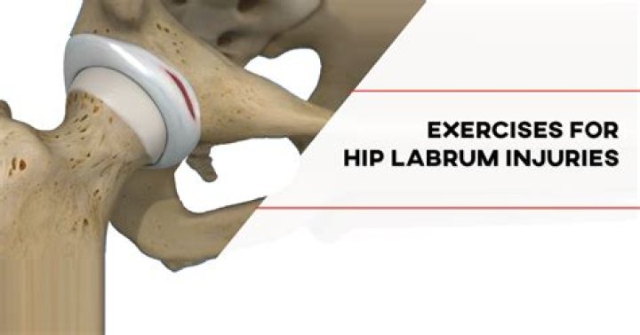 Can I exercise with a torn hip labrum?