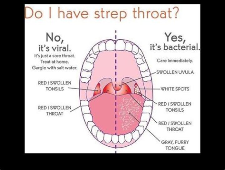 Can I get strep throat without tonsils?