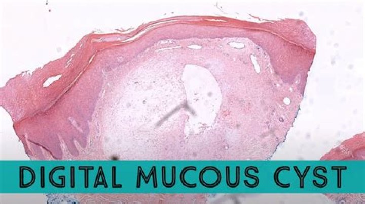 Can I pop a myxoid cyst?