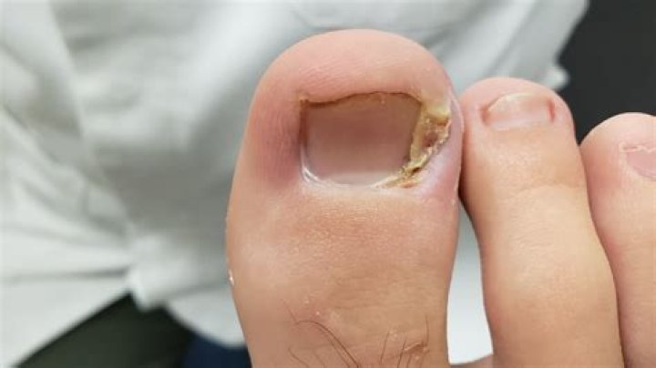 Can I put a bandaid on my toe?