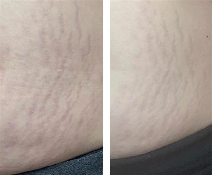 Can I use Bio-Oil on my stretch marks?