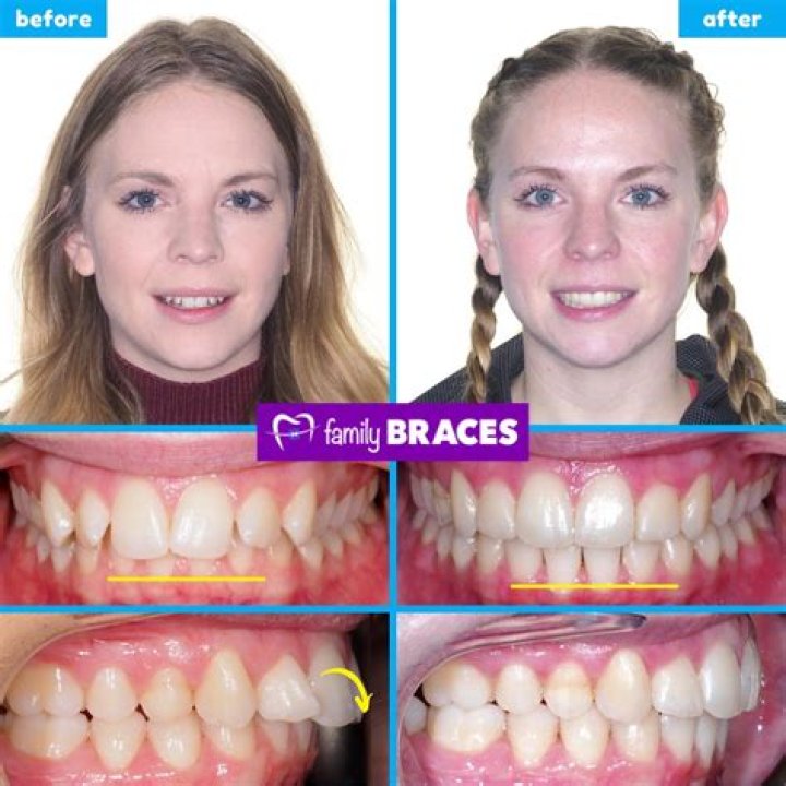 Can Invisalign fix an end to end bite?