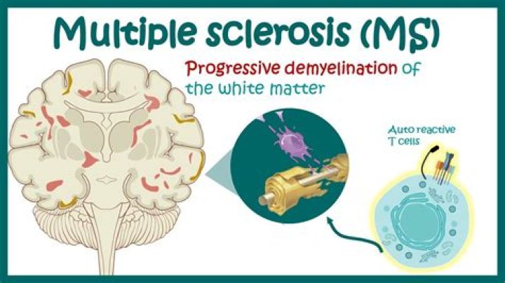 Can IVIG be used for multiple sclerosis?
