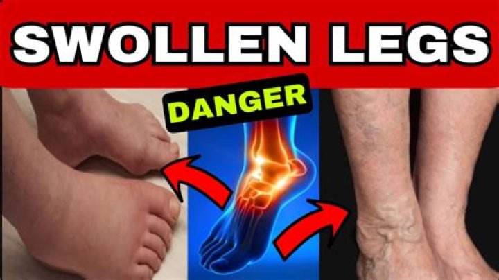 Can kidney problems cause legs and feet to swell?