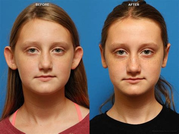 Can kids get otoplasty?