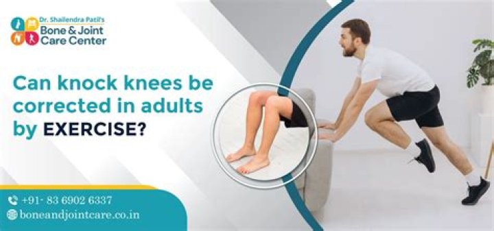 Can knock knees be corrected with exercises?