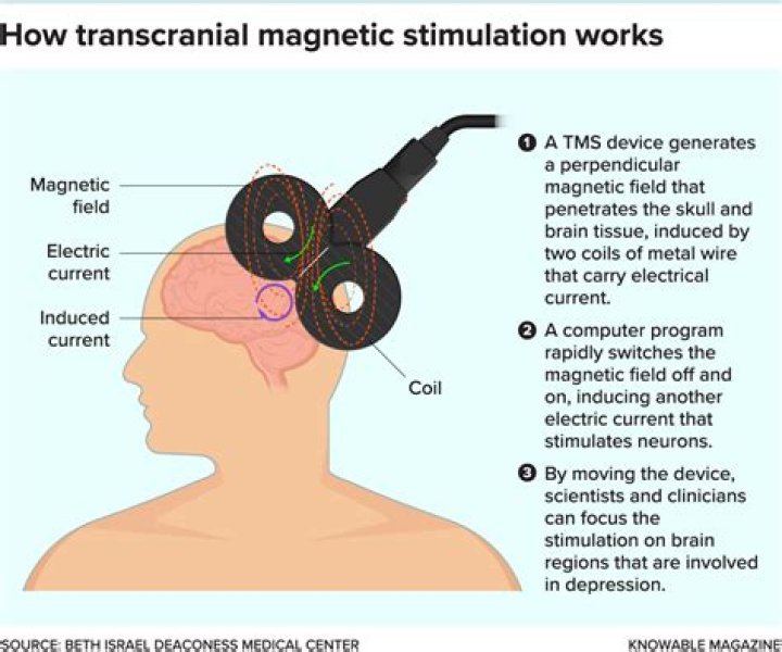 Can magnets treat depression?