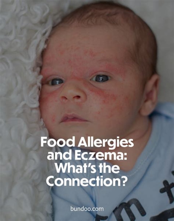 Can milk cause eczema in toddlers?