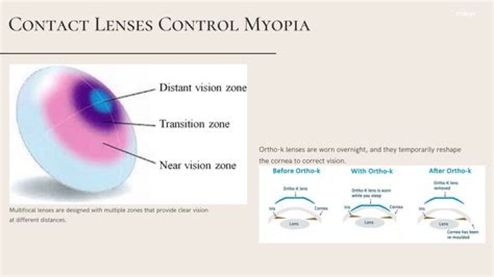 Can myopia use contact lens?