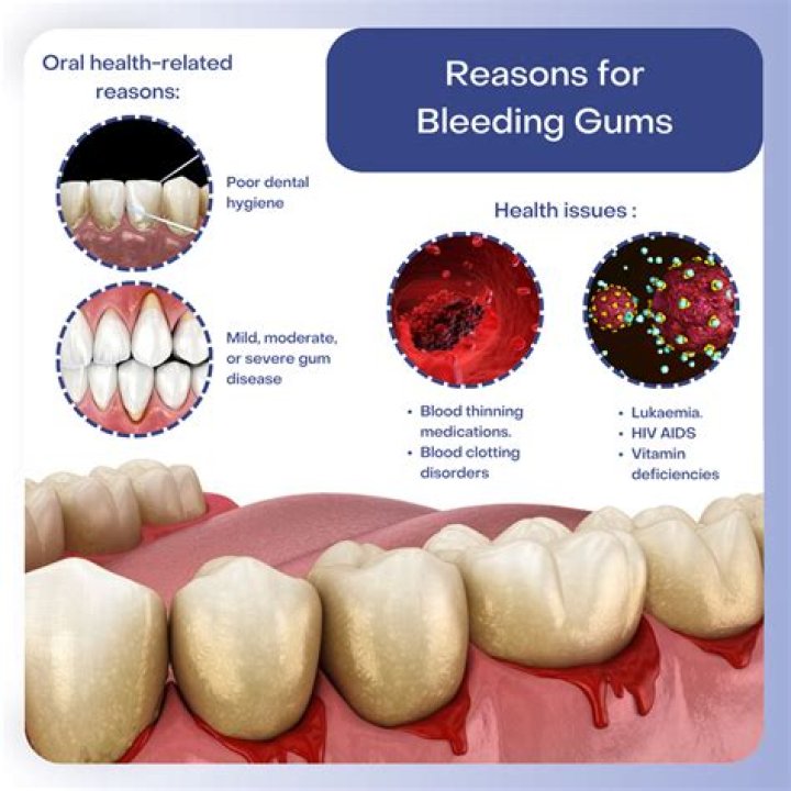 Can nose bleeding lead to death?