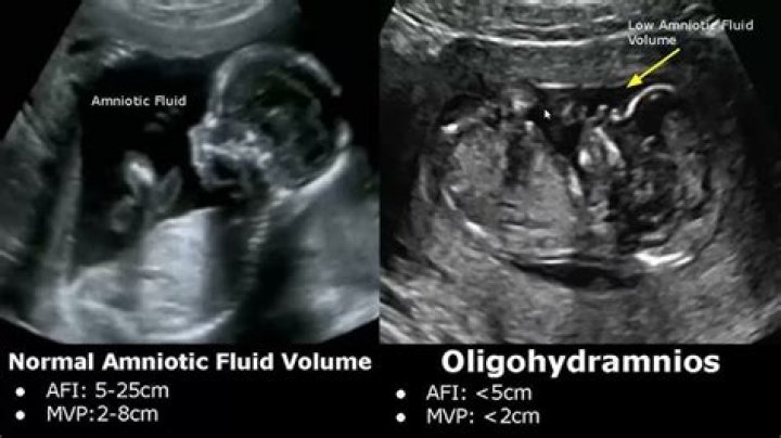 Can Oligohydramnios cause IUFD?