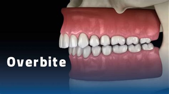 Can oral surgery fix an overbite?