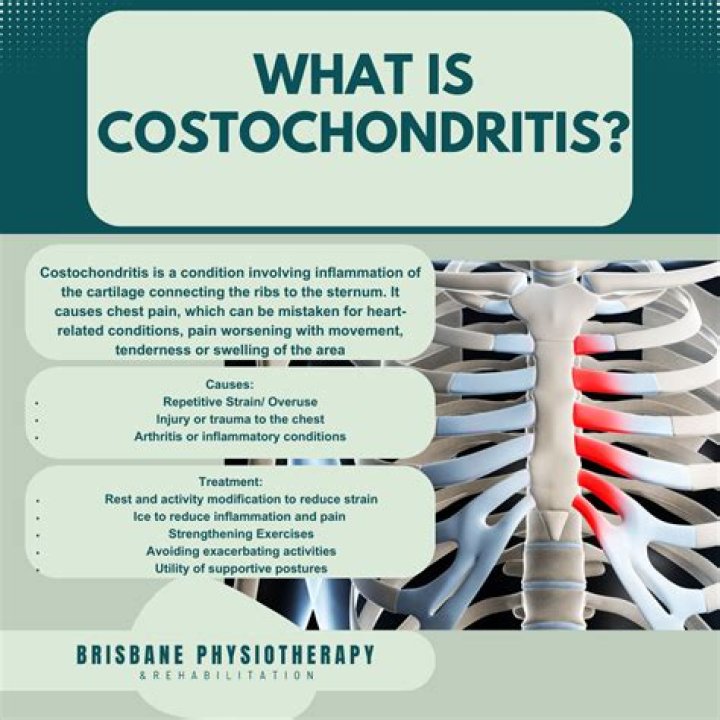 Can physiotherapy help costochondritis?
