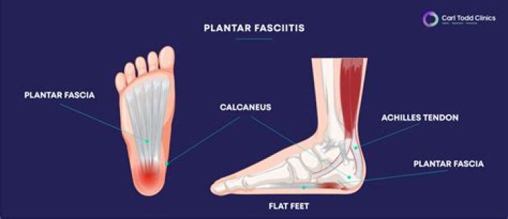 Can Plantar fasciitis cause numbness in the foot?