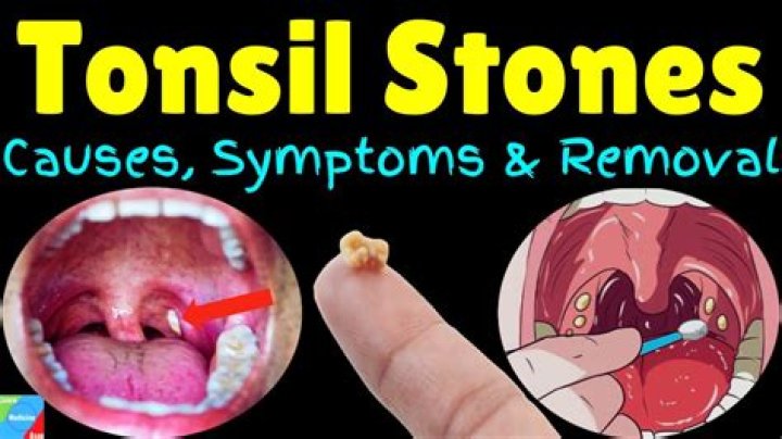 Can post-nasal drip cause red tonsils?