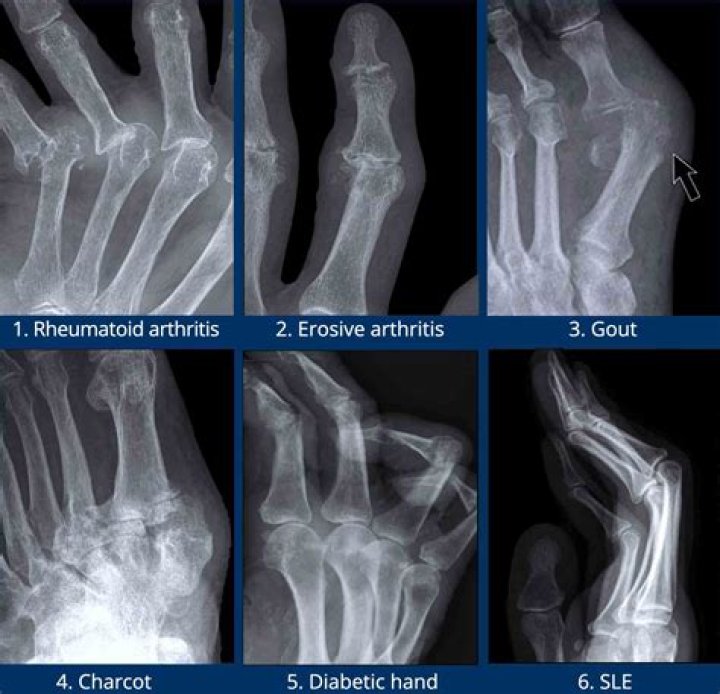 Can rheumatoid arthritis be detected by MRI?